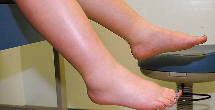 Come mai le gambe si gonfiano?