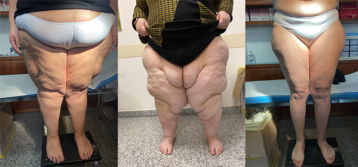 Il trattamento del lipedema e del grasso delle gambe a Milano