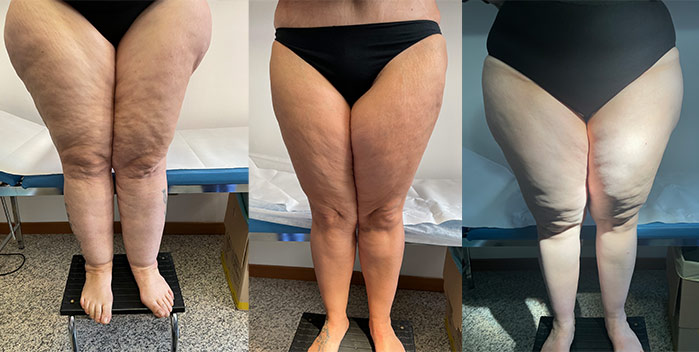 Il trattamento del lipedema e del grasso delle gambe a Milano