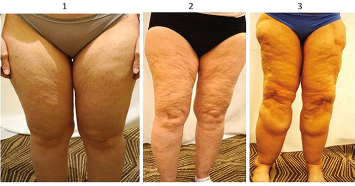 Il trattamento del lipedema e del grasso delle gambe a Milano