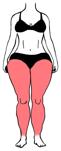 Lo stato di obesità e il linfedema