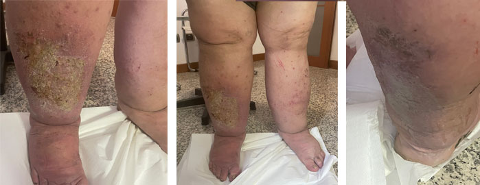 Lipo-linfedema su paziente gravemente obeso