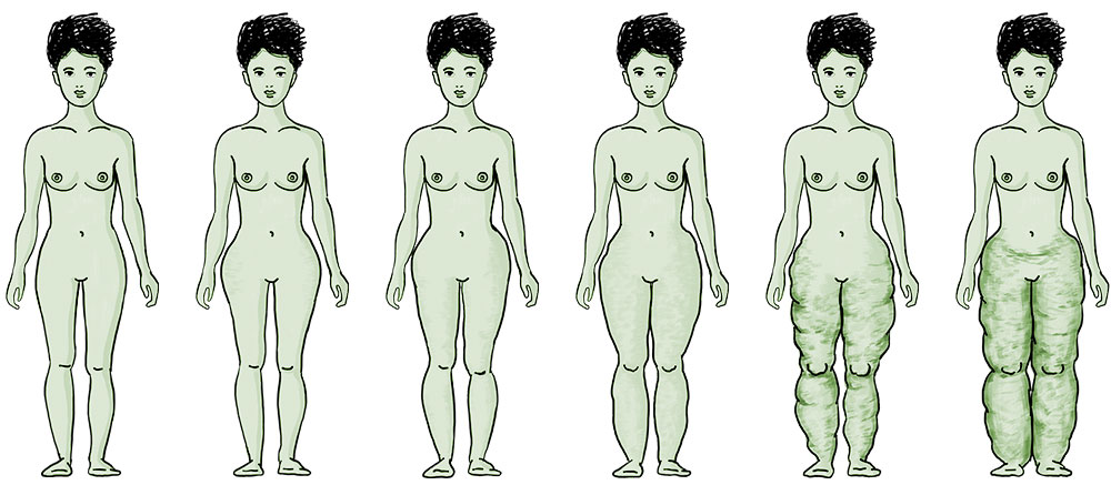 Gli stati di gravità del lipedema