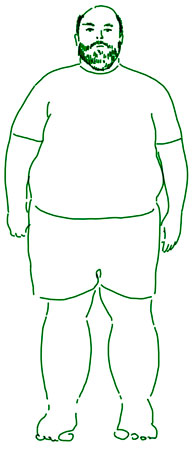 La correlazione obesità e linfedema