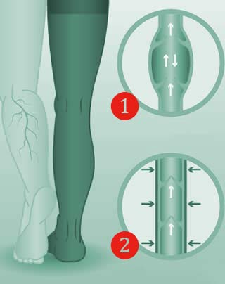 Il trattamento del linfedema a Milano