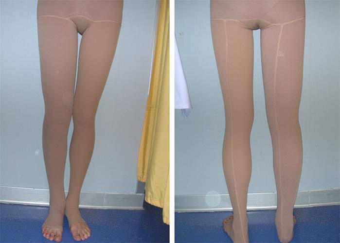 Le calze ed i tutori elastici: il benessere per le tue gambe