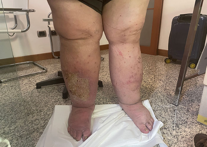 Linfedema grave e obesità
