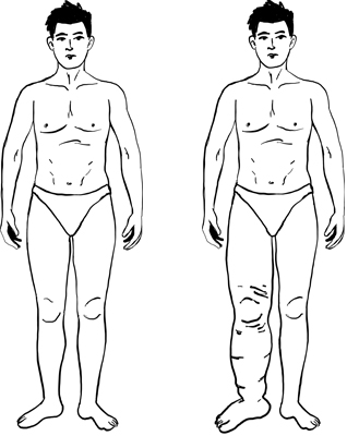 Il trattamento del linfedema a Milano