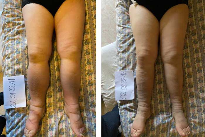 Il trattamento del linfedema a Milano