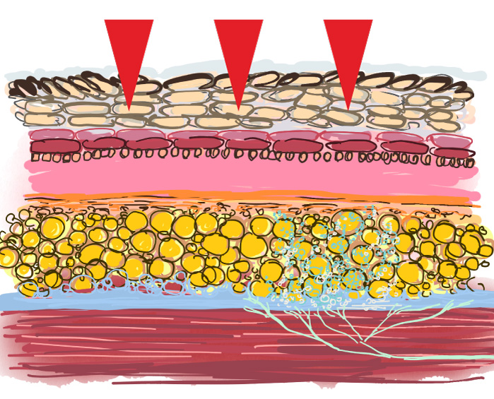 Cavitazione Medica: come funziona e come distrugge le cellule di grasso