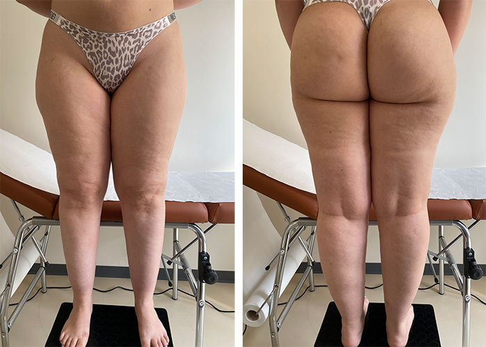 Il trattamento del lipedema e del grasso delle gambe a Milano