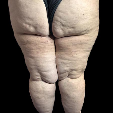 Il lipedema: cos'è e come si cura, Malattie, cure, ricerca medica