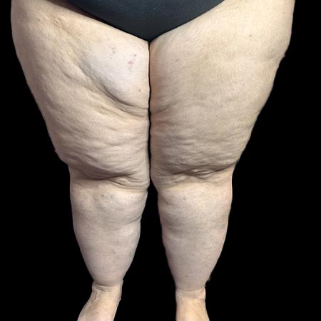 Lipedema di V tipo, fronte corpo