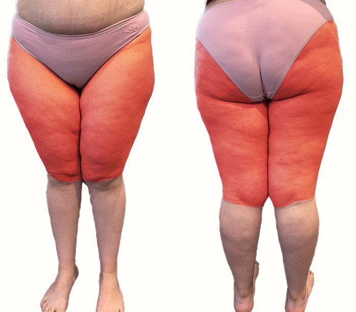 Il trattamento del lipedema e del grasso delle gambe a Milano