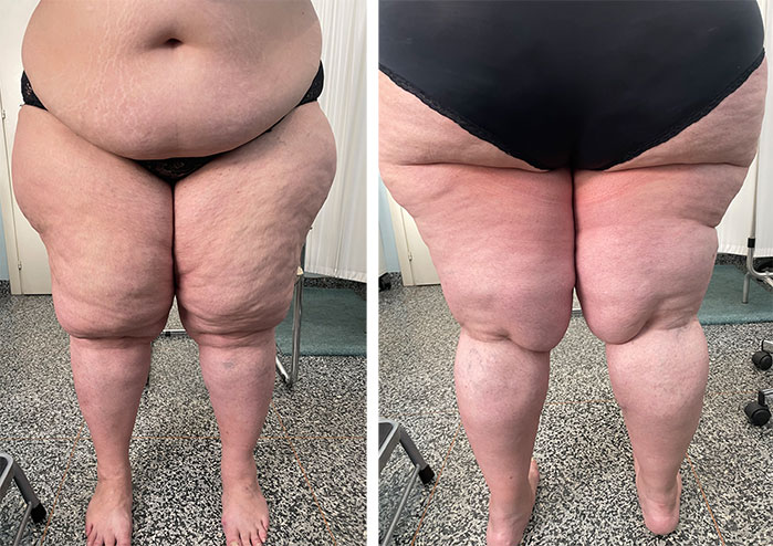 Un rapido aiuto per il lipedema a Milano