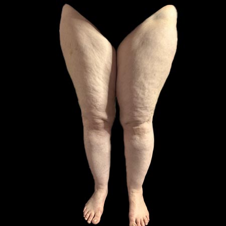 Un rapido aiuto per il lipedema a Milano