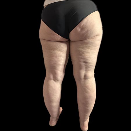 Lipedema di V tipo, retro corpo