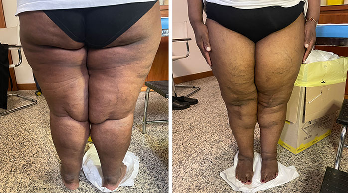 Lipedema, che cos'è? Cause, sintomi, cura.