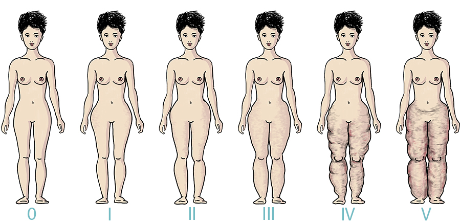 I vari stadi del lipedema e dell'accumulo patologico di grasso sul corpo femminile