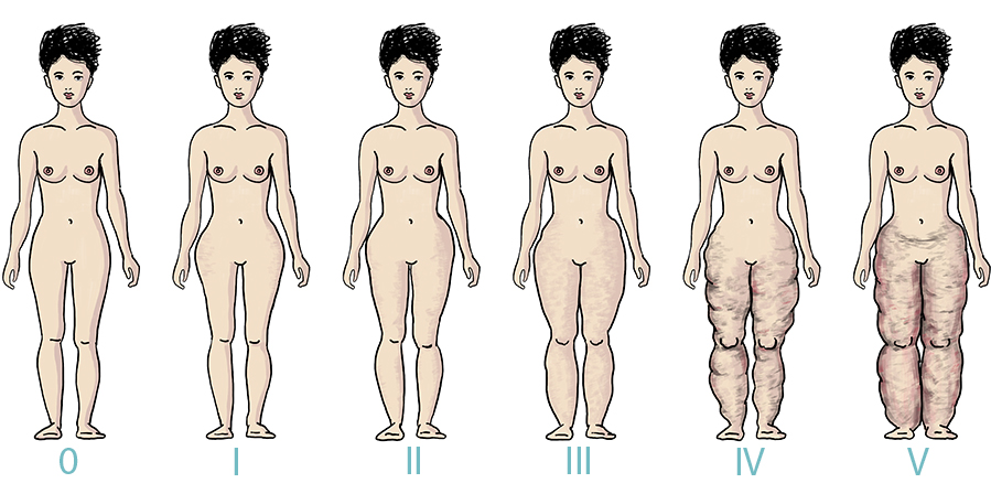 Gli stadi dell'accumulo di grasso del lipedema