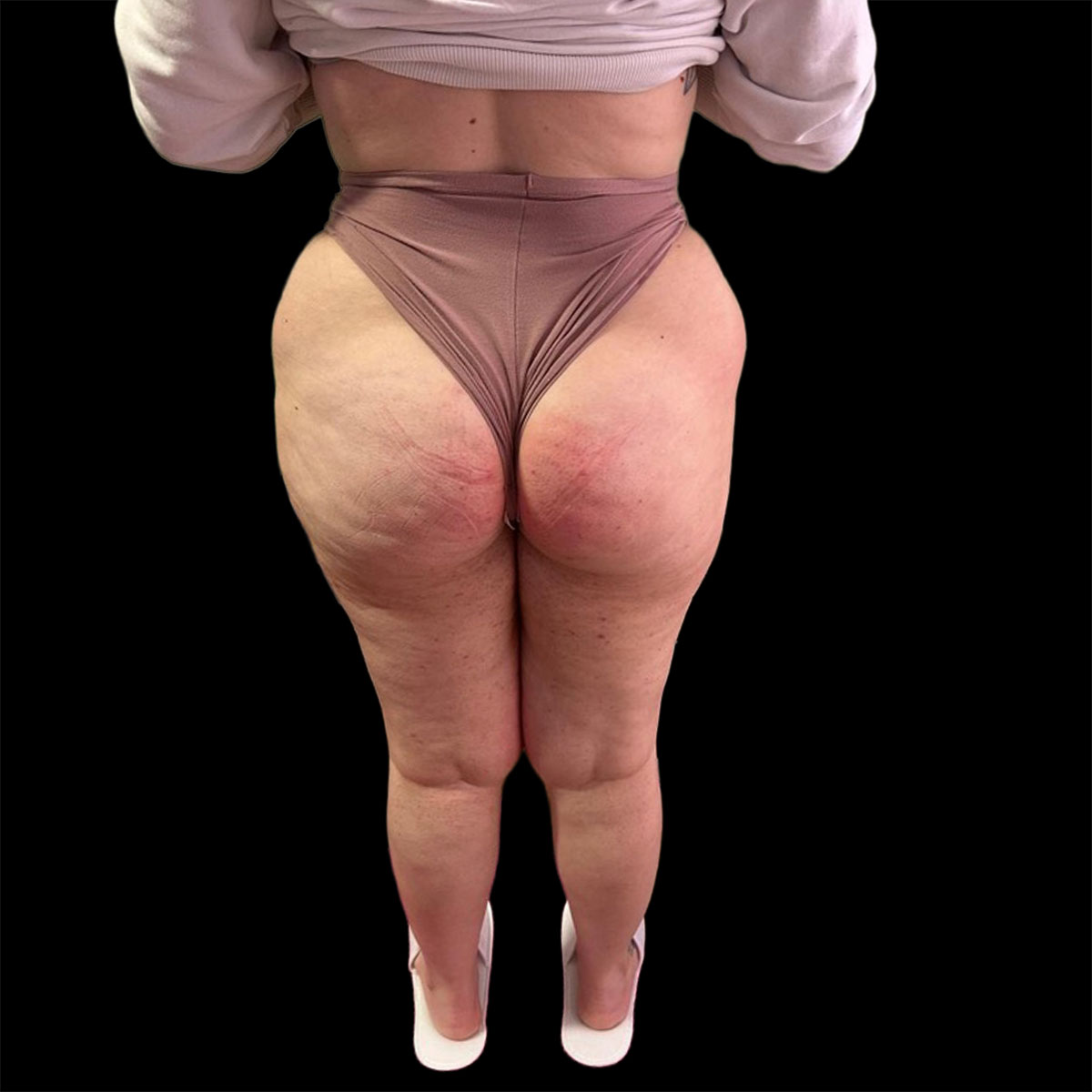 Lipedema di II tipo, IV stadio, prima della liposuzione