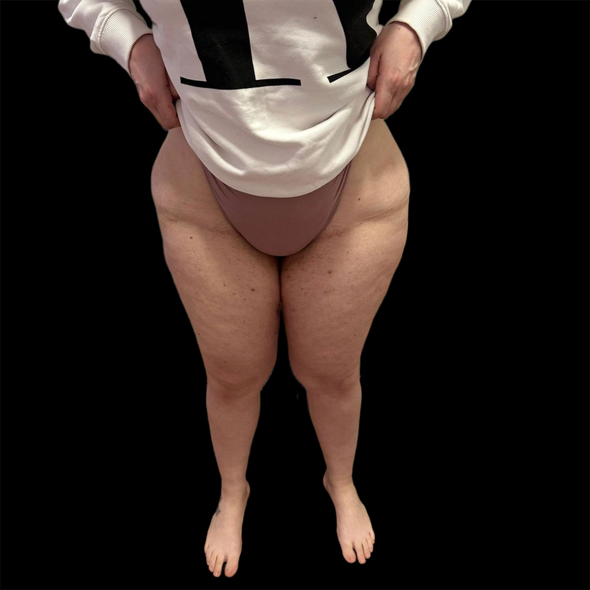 Lipedema di II tipo, IV stadio, prima della liposuzione