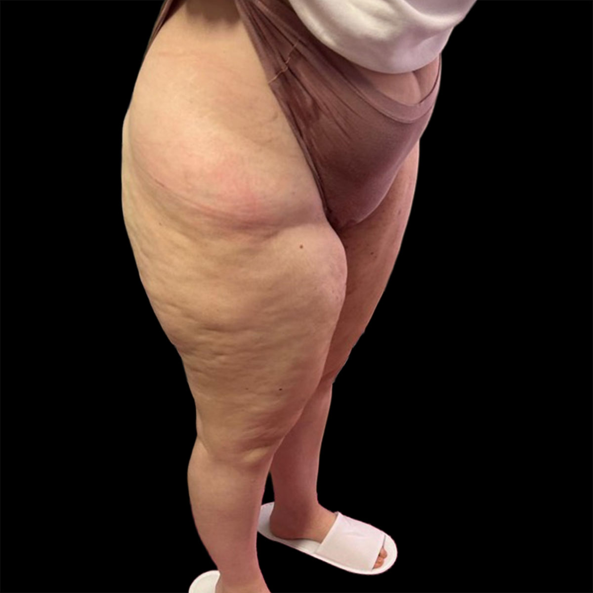 Lipedema di II tipo, IV stadio, prima della liposuzione
