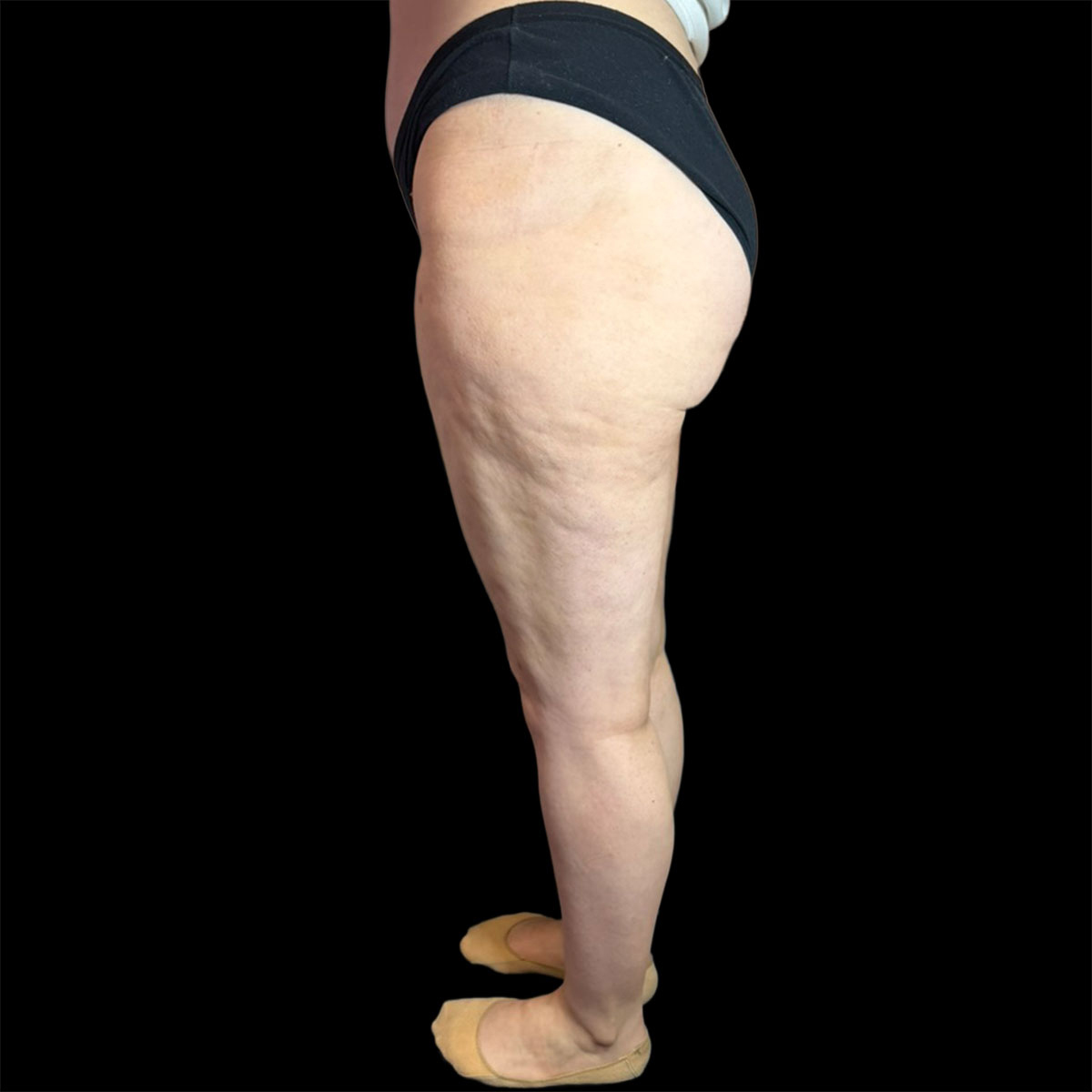 Lipedema di II tipo, IV stadio, dopo della liposuzione
