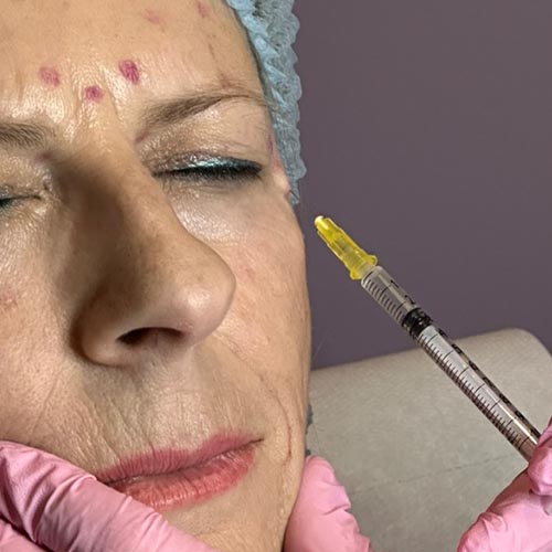 Botox a Milano