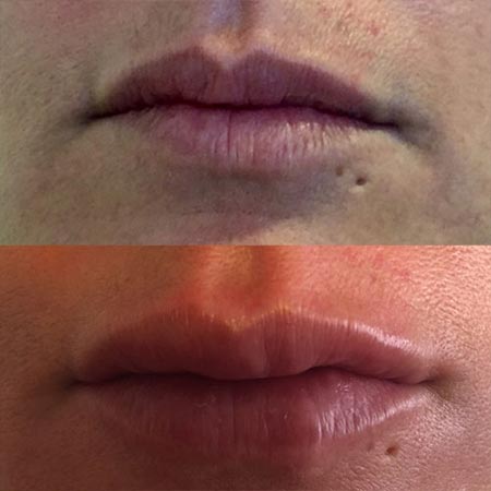 Filler acido ialuronico in centro a Milano