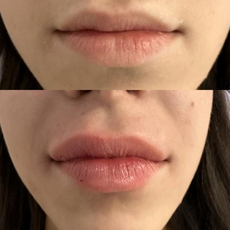 Filler acido ialuronico in centro a Milano