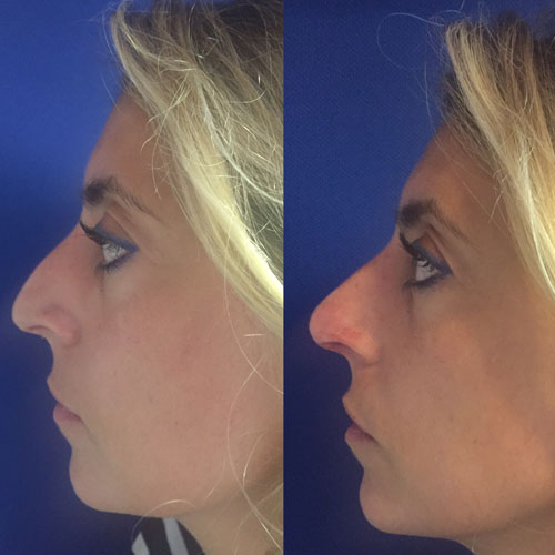 Filler acido ialuronico in centro a Milano