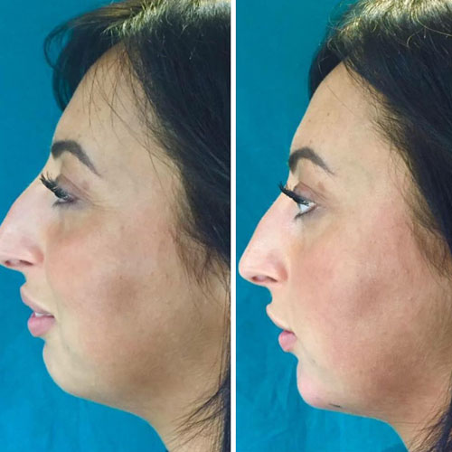 Filler acido ialuronico in centro a Milano