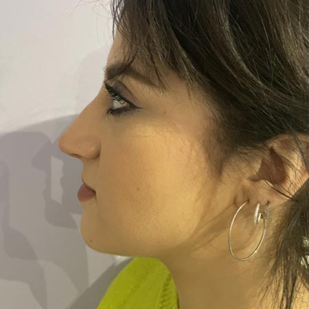 Filler acido ialuronico in centro a Milano