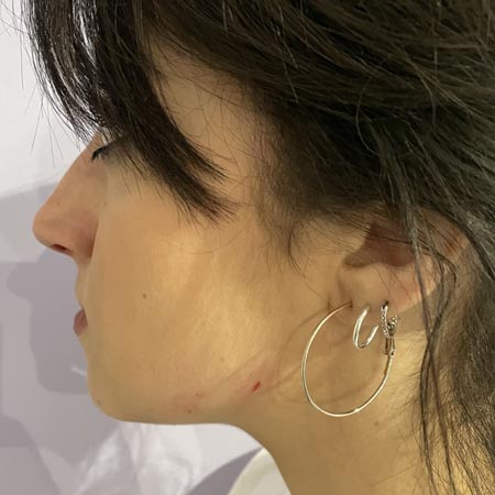 Filler acido ialuronico in centro a Milano