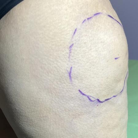 Fosfatidilcolina per mesoterapia Lipodissolve