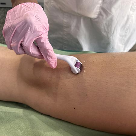 Microonedling, seduta con acido ialuronico