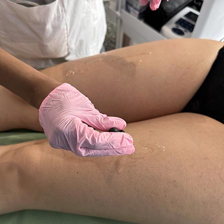 Microonedling, seduta con acido ialuronico