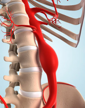 L'aneurisma dell'aorta e lo screening aortico