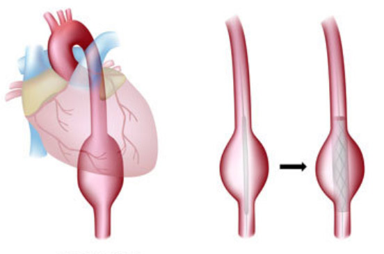 L'aneurisma dell'aorta e lo screening aortico