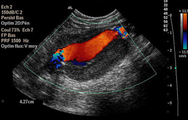 L'aneurisma dell'aorta e lo screening aortico