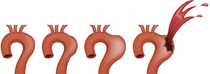 L'aneurisma dell'aorta e lo screening aortico