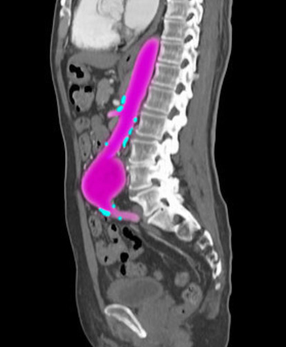 L'aneurisma dell'aorta e lo screening aortico