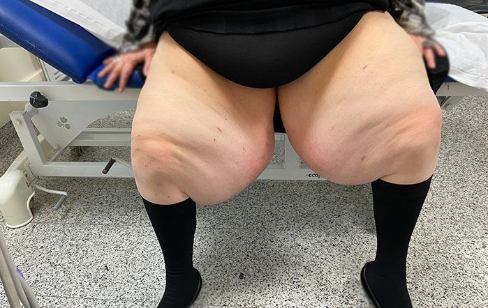 Il trattamento del lipedema e del grasso delle gambe a Milano