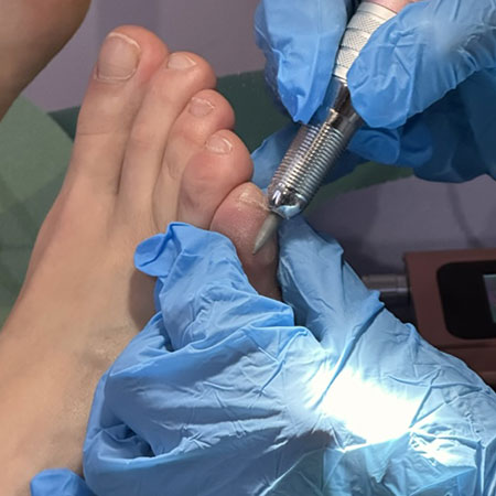 Pedicure per la rimozione dei calli a Milano