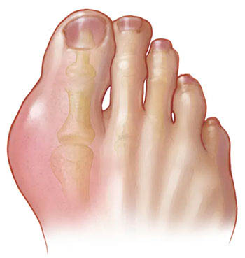 La diagnosi e la cura della gotta