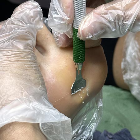 Pedicure sanitaria occhio di pernice