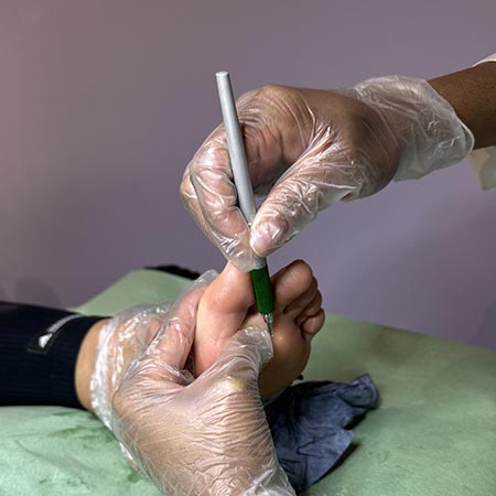 Pedicure sanitaria occhio di pernice