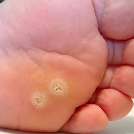 Pedicure sanitaria occhio di pernice