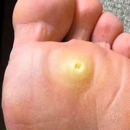 Pedicure sanitaria occhio di pernice